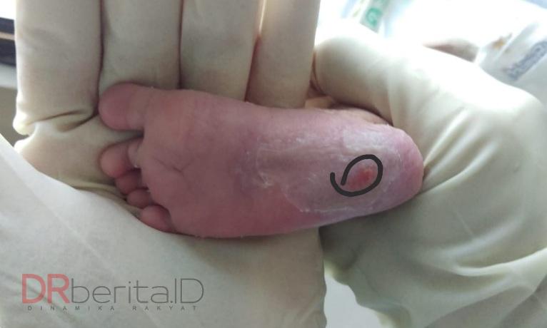 Polda Sumut Periksa 3 Dokter RSU Mitra Medika Kasus Bayi Korban Dugaan Malpraktek